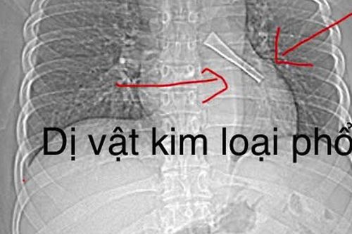 Ho không dứt, bác sĩ phát hiện cán thìa inox mắc trong phế quản bệnh nhân
