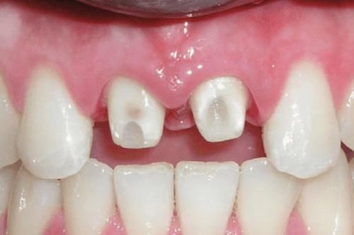 Trước khi mài răng để bọc sứ, đừng quên 4 câu hỏi này