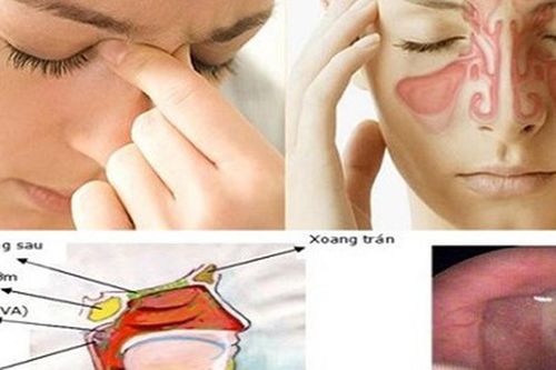 Viêm mũi xoang mùa mưa: Đừng chủ quan với những cơn nghẹt mũi kéo dài