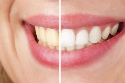 4 hệ lụy nếu tẩy trắng răng sai cách