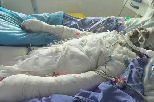 Chàng trai 20 tuổi hiến da cứu cha bị bỏng 95% sau vụ nổ khí gas, câu nói gây xúc động