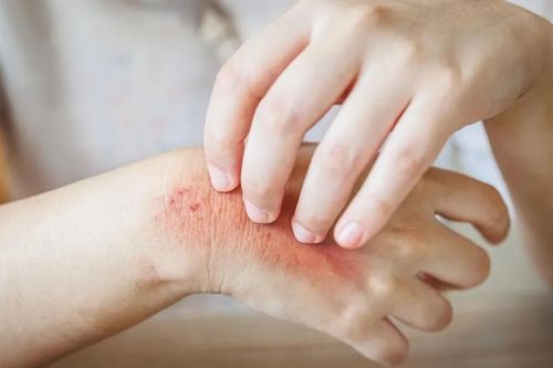 Cách nhận biết và phòng tránh bệnh da thường gặp mùa hè