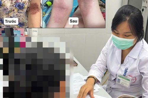 Người phụ nữ thoát cảnh 6 năm quấn khăn quanh người nhờ phác đồ đặc biệt