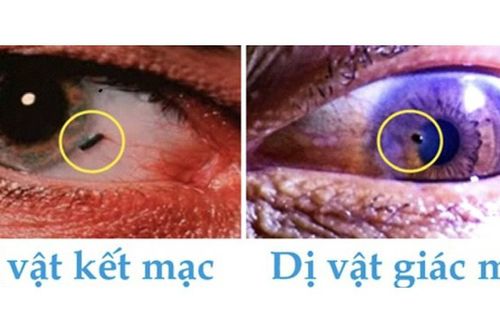 Cảnh báo dị vật mắt khi lao động gây thủng giác mạc