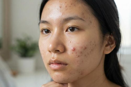 5 cách ngăn ngừa mụn trứng cá trong kỳ kinh nguyệt