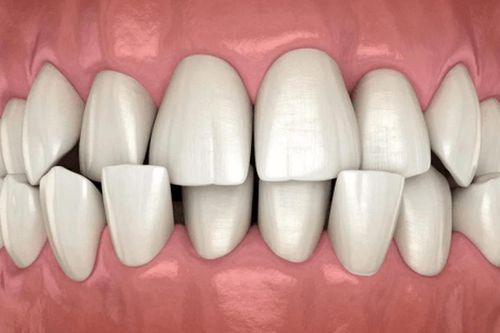 10 dấu hiệu cần chỉnh nha sớm ở trẻ em, đừng đợi đến khi con mọc đủ răng mới đi khám