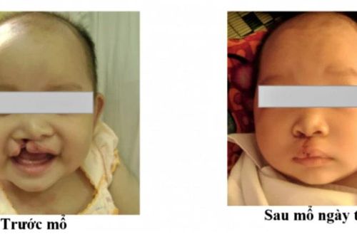 Nghệ An tiếp nhận viện trợ chăm sóc trẻ em bị dị tật khe hở môi, vòm miệng