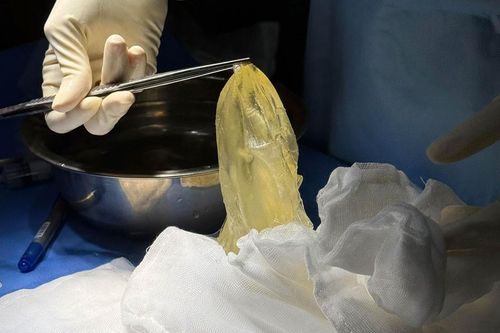 Dấu hiệu cảnh báo vỡ túi ngực sớm không nên bỏ qua