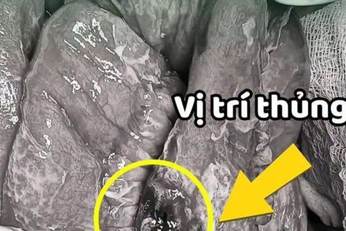 Chủ quan trước cơn đau bụng, người đàn ông bất ngờ phát hiện ung thư hiếm gặp
