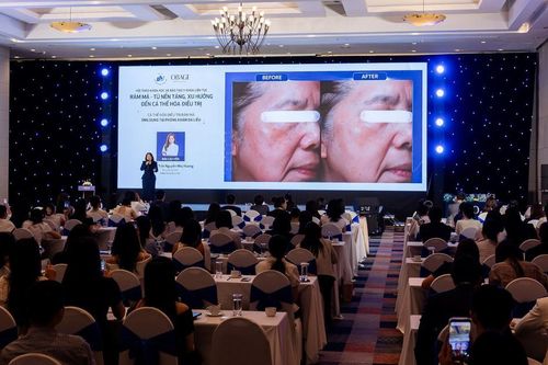 Rám má không còn là bệnh lý thẩm mỹ đơn thuần