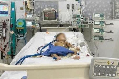 44 giờ lọc máu giành sự sống cho bé trai 14 tháng tuổi bị ong đốt 20 vết