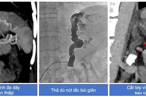Nút tắc tĩnh mạch cứu bệnh nhân xuất huyết dạ dày