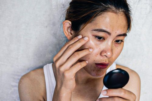 5 thói quen hằng ngày âm thầm khiến làn da dễ bị nám, nhiều người vẫn lặp lại mà không hay biết