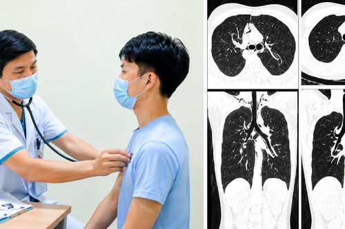 Nam thanh niên 20 tuổi tràn khí trung thất sau 1 tuần ho liên tục, bác sĩ cảnh báo dấu hiệu dễ bị bỏ qua