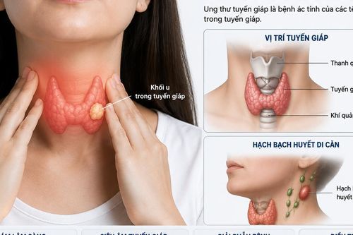 Sau mổ ung thư tuyến giáp, ai cần điều trị I-131?