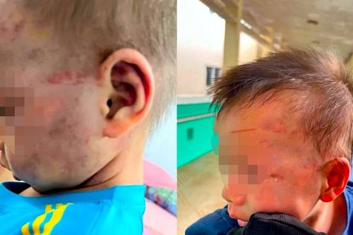 Tạm giữ cha dượng đánh bé 3 tuổi bầm tím mặt mũi