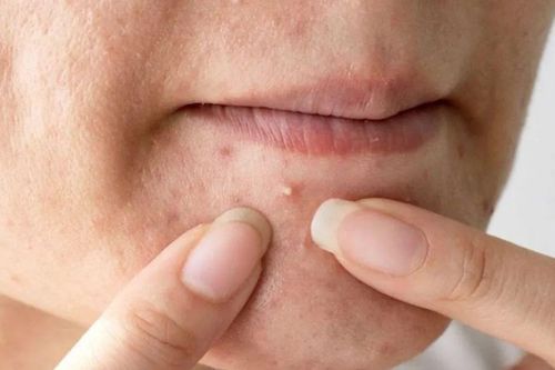 Mẹo chăm sóc da sau khi nặn mụn đúng cách: 5 bước giúp da nhanh lành, hạn chế thâm sẹo