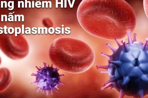 Đồng nhiễm HIV và nấm Histoplasmosis: Phát hiện sớm để giảm nguy cơ tổn thương phổi và tử vong