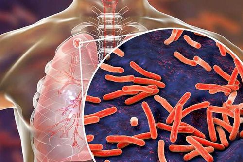 Ho ra máu khi nào cần nhập viện cấp cứu?