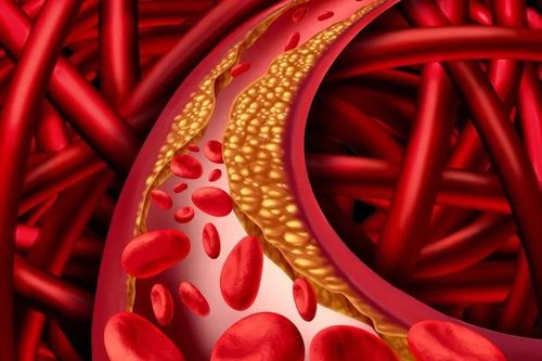 Người có thể trạng gầy vẫn bị rối loạn mỡ máu
