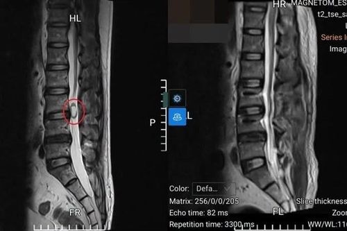 Đau lưng kéo dài, người đàn ông 47 tuổi phát hiện u tủy sống