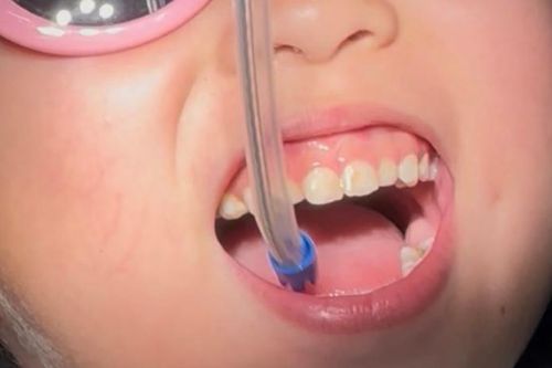Lý do tiến sĩ dược làm việc ở Mỹ đưa con về Việt Nam chữa răng sâu