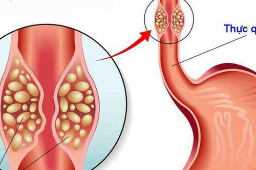 Triệu chứng hẹp thực quản: Đừng chủ quan khi thường xuyên nuốt nghẹn