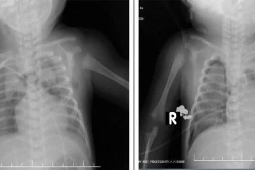 Cứu sống trẻ sơ sinh 1 ngày tuổi suy hô hấp nguy kịch do thiếu surfactant