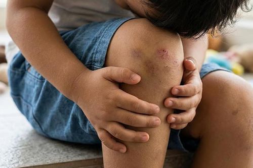 Té ngã, va đập ở học sinh, cách nào phòng tránh hiệu quả?