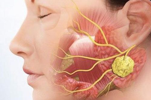 Sưng đau vùng mang tai, coi chừng bệnh lý tuyến nước bọt