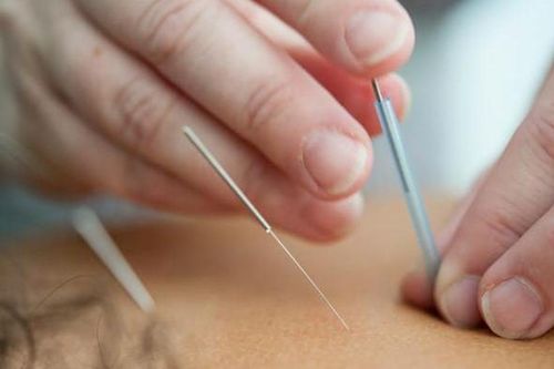 Đau chân dữ dội sau khi châm cứu, người phụ nữ sốc nặng khi biết sự thật đáng sợ