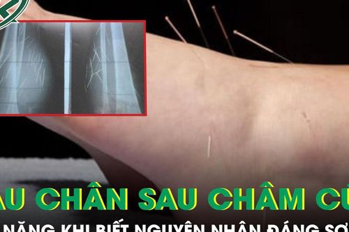 Đau chân dữ dội sau châm cứu, người phụ nữ sốc nặng khi biết nguyên nhân