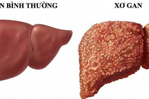 Chưa bị xơ gan vẫn có thể mắc ung thư gan