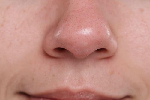 Mụn đầu đen tái đi tái lại dù chăm da kỹ? Nguyên nhân có thể nằm ở những thói quen hằng ngày của bạn