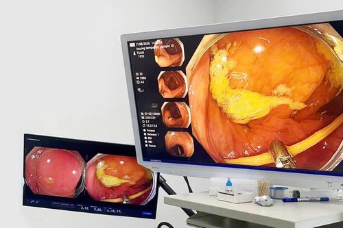Nội soi lấy thành công tăm tre đâm thủng ruột non của bệnh nhân