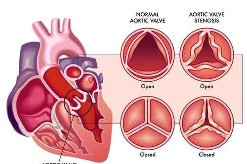 Nặng chân cuối ngày, cảnh giác dấu hiệu bệnh van tim