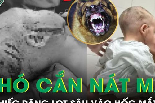 Bé trai 2 tuổi bị chó cắn nát vùng mặt
