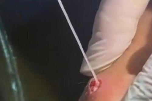 Cẳng tay xuất hiện nốt trắng, người đàn ông kéo ra con giun dài hơn 20cm