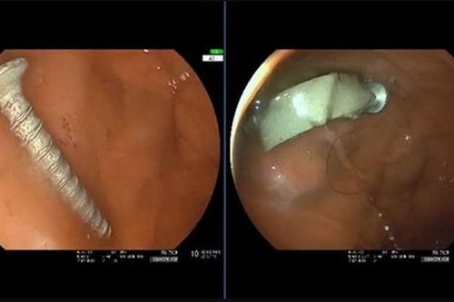 Bé gái 11 tháng tuổi nuốt đinh vít dài 4cm, bác sĩ cảnh báo phụ huynh