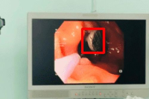 Ngậm đinh trong miệng, người đàn ông 50 tuổi gặp sự cố đáng sợ