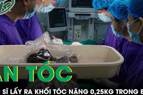 Bé gái ăn tóc nhiều năm, bác sĩ lấy ra khối tóc nặng 0,25 kg trong bụng