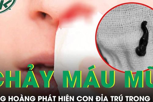 Chảy máu mũi suốt một tháng nam thanh niên phát hiện con đỉa trú trong mũi