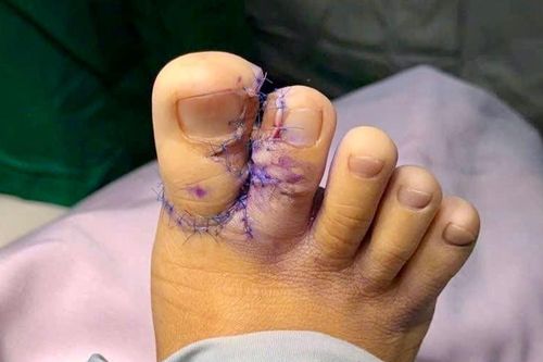 Bệnh viện II Lâm Đồng: Phẫu thuật thành công ca dị tật dính ngón chân bẩm sinh hiếm gặp