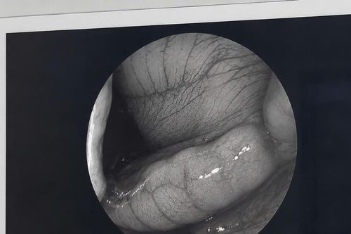 Chảy máu mũi kéo dài một tháng, nam thanh niên bất ngờ phát hiện đỉa trong khoang mũi