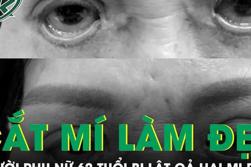 Biến chứng cắt mí thẩm mỹ, người phụ nữ 62 tuổi bị lật cả hai mi dưới