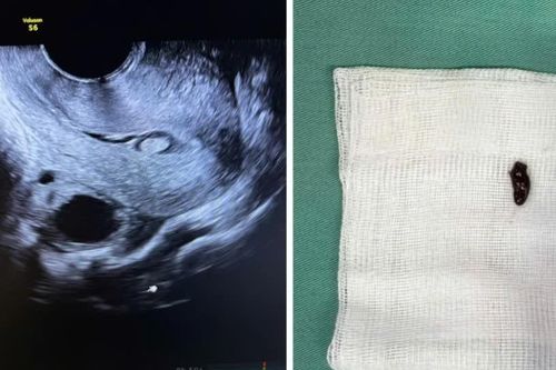 Phát hiện polyp buồng tử cung trước IVF, khi nào cần cắt?