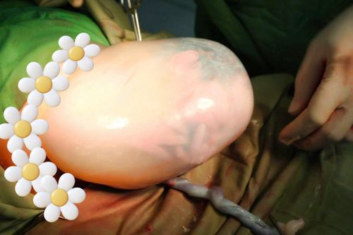 Bé gái 'đẻ bọc điều' trong ca sinh đôi ngày Quốc khánh