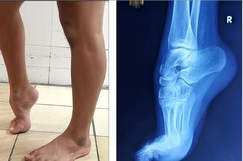 Phẫu thuật thành công ca dị tật 'bàn chân thuổng' bẩm sinh phức tạp