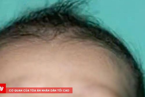 Bác sĩ Hàn Quốc phẫu thuật miễn phí cho trẻ mắc dị tật