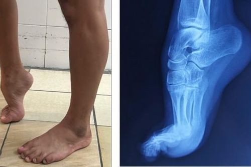 BV Trường ĐH Y Dược Huế phẫu thuật thành công ca bàn chân thuổng bẩm sinh ở người lớn